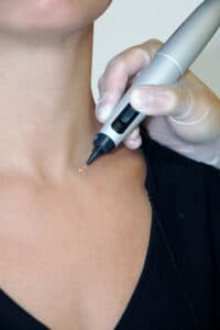 CryoPen O+ Starter Set ,4 Applicators ,6 gaspatronen 16gr 2