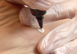 CryoPen O+ Starter Set ,4 Applicators ,6 gaspatronen 16gr 1